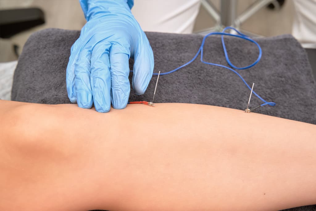 Electropunción en Arteixo: tratamientos de fisioterapia avanzada